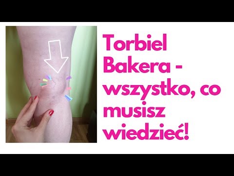 Wideo: Torbiel Kolana - Torbiel Piekarza (Beckera), Leczenie I Operacja