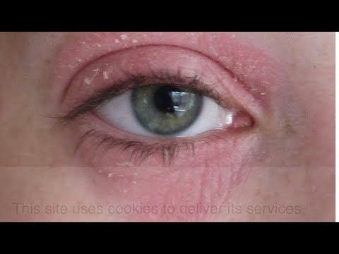 الاكزيما حول العين