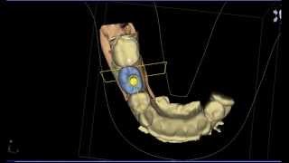 Planning Treatment in 3D