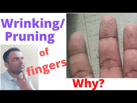 Wrinkling(Wrinkle)(Pruning)of the fingers.Is it normal/Abnormal?What is the cause for prune fingers?