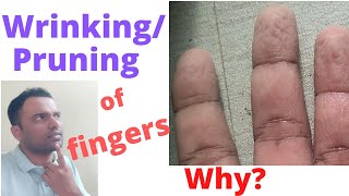 Wrinkling(Wrinkle)(Pruning)of the fingers.Is it normal/Abnormal?What is the cause for prune fingers?