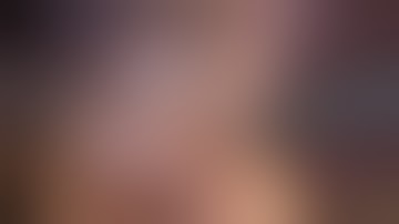 Acute Cholecystitis(Mucocele)- Laparoscopic cholecystectomy-Dr Sushil J Deshmukh,MBBS,MS,FMAS.