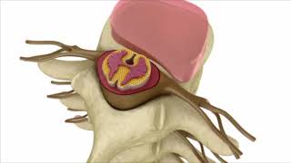 Celebrity Sciatica Explainer | ChiroUp: Evidence-Based Chiropractic Profile