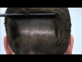 GREAT HAIR TRANSPLANT SCAR from a Hair Restoration Specialist