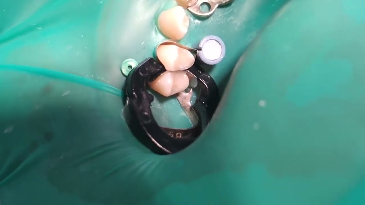 Isolation 14-12 teeth. 