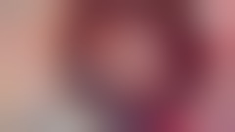 Live Marfan syndrome Subluxated Lens (cataract) CTS Double flange technique Dr Sourabh Patwardhan