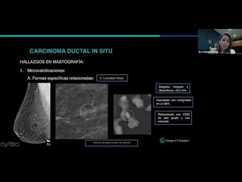 Vídeo: Sobrediagnóstico Y Sobretratamiento Del Cáncer De Mama: Tasas De Carcinoma Ductal In Situ: Una Perspectiva Estadounidense