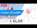 Frozen Shoulder erklärt - Die Schultersteife schmerzt und dauert