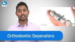 Orthodontic Separators/Spacers - What they are, and TIPS.