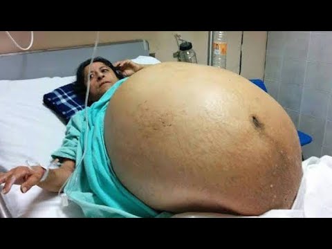 Mom Is Stunned When Her Weight Balloons To 275 Pounds, All Because Of A 132