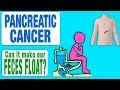 Floating Stools And Pancreatic Cancer
