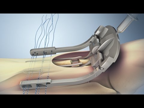 அகில்லெஸ் தசைநார் சிதைவு மற்றும் பழுது