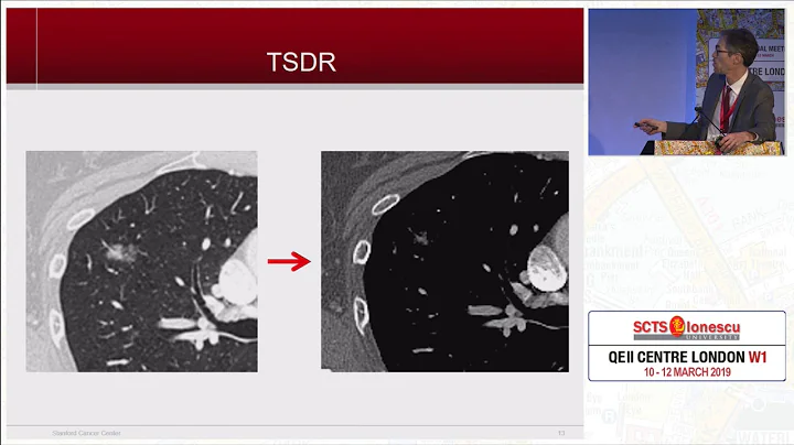 Treatment Strategy for Ground Glass Opacity and Tiny Lung Nodules - DayDayNews