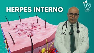 Herpes Interno - Clínica Dr. Vega