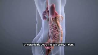 Qu'est-ce qu'une urostomie?