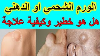 الورم الشحمي كيفية علاجة... موضوع شامل