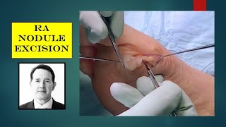 Video - surgical excision of a rheumatoid nodule