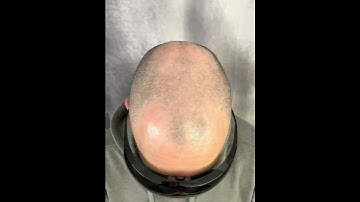 Hair tattoo, Scalp Micro Pigmentation, Guaranteed hair loss solution!