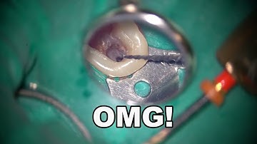 Removal of the non-visible broken file and another self-fractured file/他人のファイルと自分で破折したファイルの除去