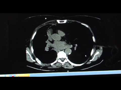 can a pet scan tell if you have lung cancer