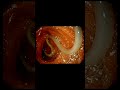 Endoscopic view of Ascaris in the gastric lumen #doctor #medical #doctor #hospital #medicalstudent