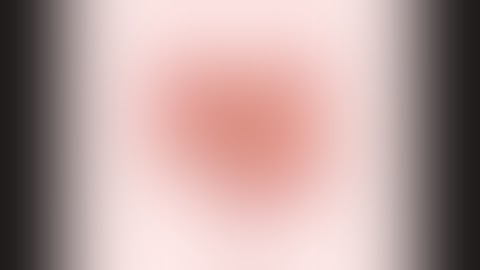 Part 2 - rSalvage Proctectomy  - the Proctectomy