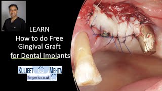Free Gingival Graft Surgery on Dental Implants by Dr Kuljeet Singh Mehta-Periodontist 4,178 views 7 months ago 27 minutes