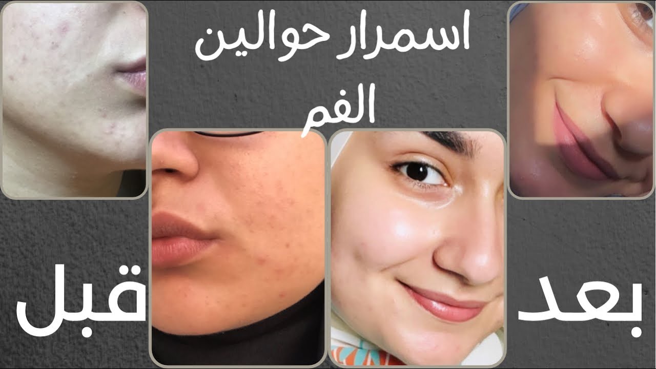 أسباب غمقان و أسمرار حول الفم-وازاي قدرت أتخلص منه وايه المنتجات المناسبة