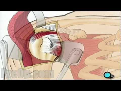 Rotator Cuff Repair Open - PreOp Patient Education Surgery HD