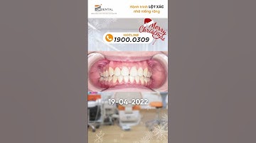 Hành trình LỘT XÁC nhờ niềng răng của Phương Uyên