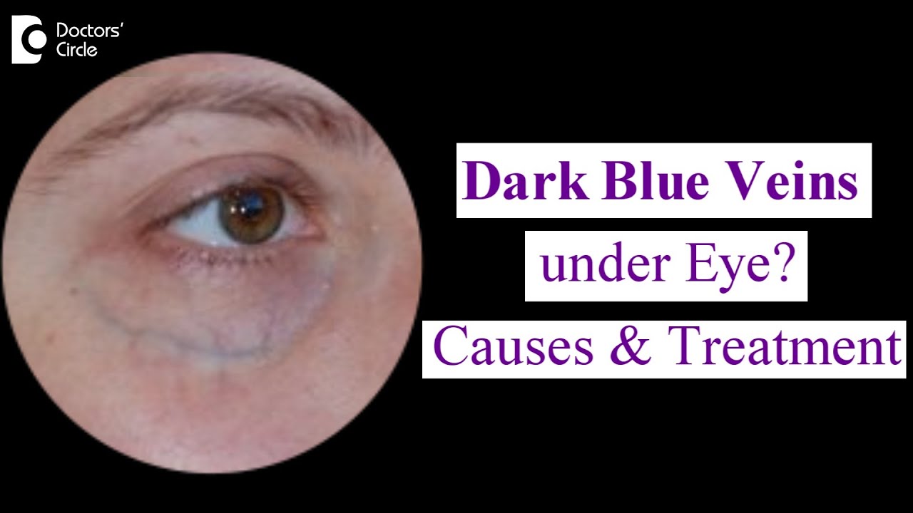 Blue Ring Around Eye: Pictures, Causes & Treatment