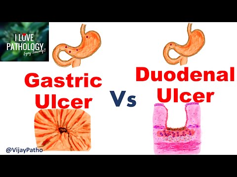 Video: Ulcerul duodenal provoacă gaze?