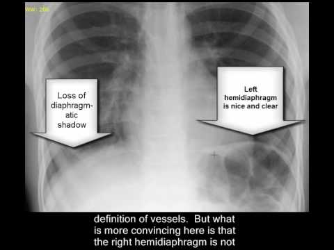 chest x ray pneumonia