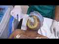 Anesthesia Preparation for Rhinoplasty Surgery