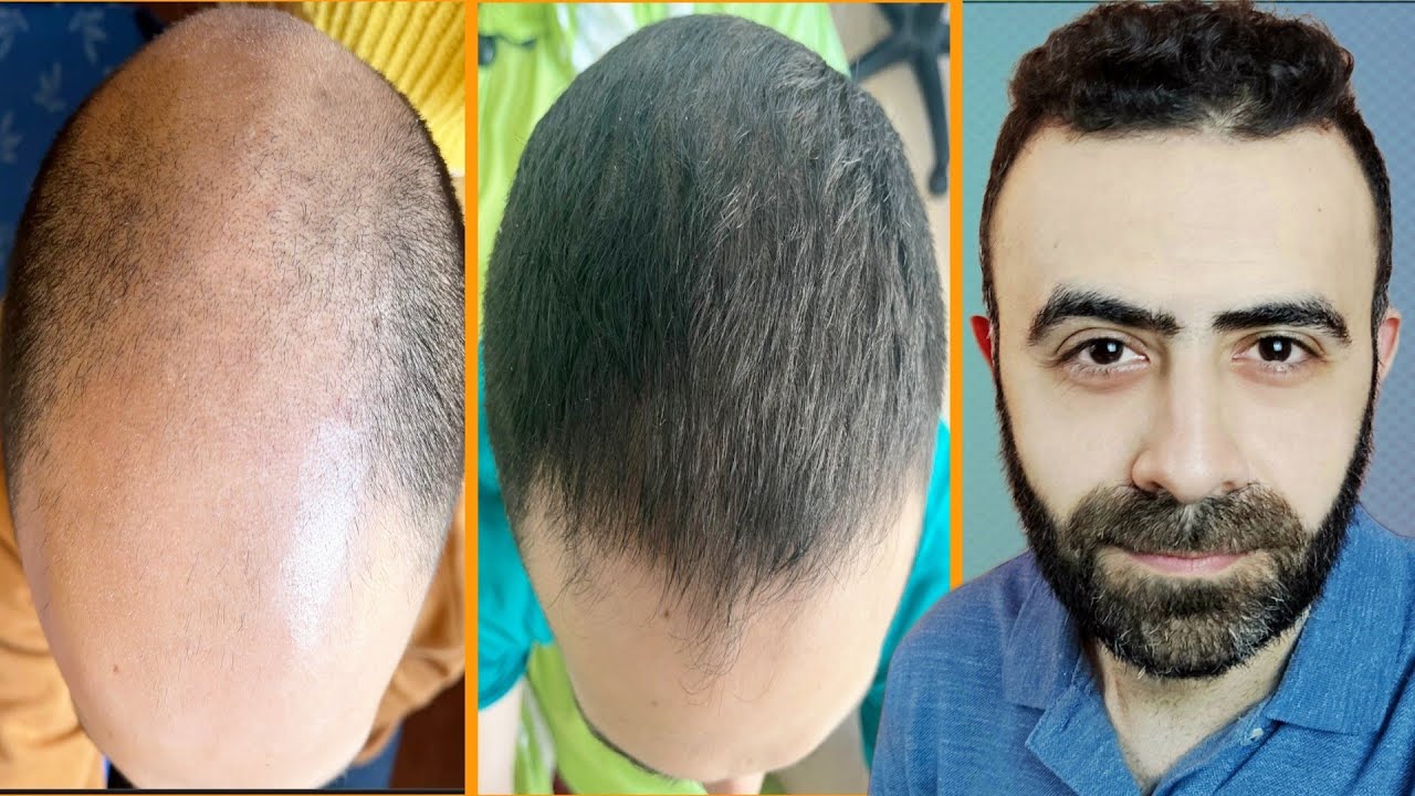 اليهما افضل لعلاج الصلع الوراثي عند الرجال المينوكسيديل 5 ام الفيناسترايد ( تجربة من ارض الواقع )