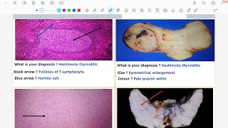 Pathology practical of endocrine module 