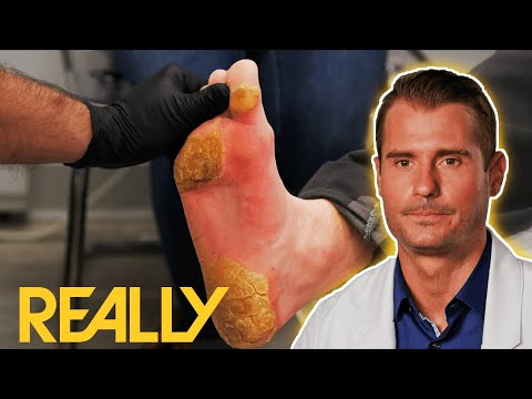 "I've Never Seen Calluses This Big Before!" | My Feet Are Killing Me