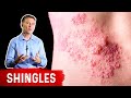Why Is Everyone Getting Shingles?