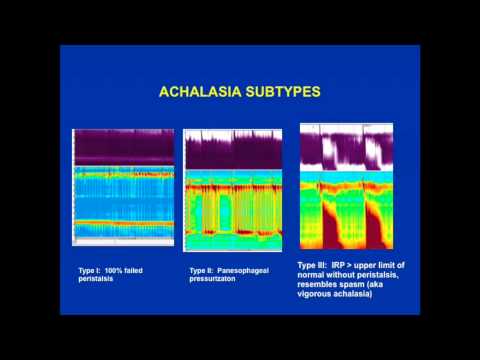 Video: Ruokatorven Achalasia - Hoito, Oireet, Syyt