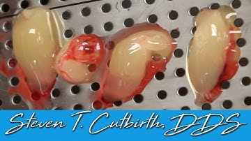 The Best Molar Extraction & Socket Preseravtion Technique