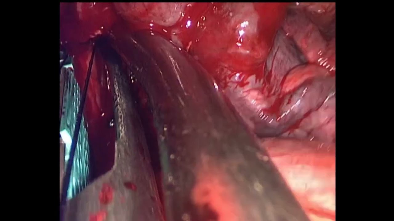 Nonintubated subxiphoid uniportal VATS right middle lobectomy