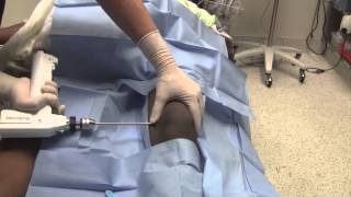 Hip Dislocation Reduction and Traction Pinning