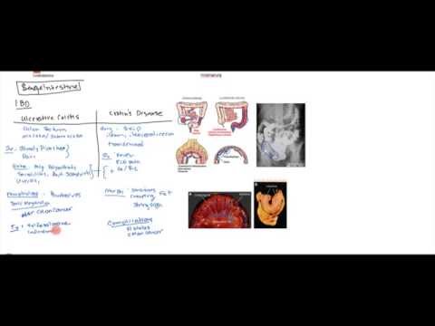 Inflammatory Bowel Disease (Crohn&rsquo;s and Ulcerative Colitis) for USMLE Step 1