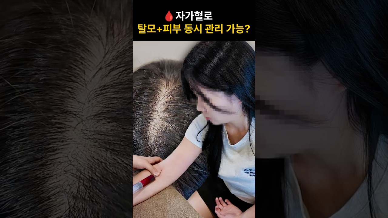 [Селдөөён Эмнэлэг] Өөрийн цусаар нүүр болон хуйхны арчилгаа хийнэ гэж үү?! Үндсэн эсийн PRP хөтөлбөрийн бүрэн курсийг дэлгэлээ💉