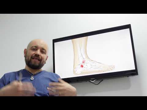 Ayak bileği bağ hasarı (Op. Dr. Barış Özgürol)