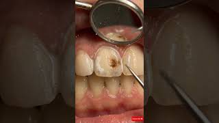 Dark Tooth Spot Removal 😱 Full Whitening Transformation#dentalvideos #whiteteeth #dentalasmr