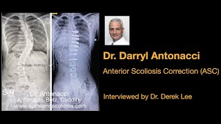 Dr. Darryl Antonacci, Anterior Scoliosis Correction (ASC) Non-Fusion Surgery, by Dr. Derek Lee