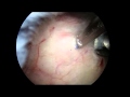 Arthroscopic removal of calcium deposit from shoulder (calcific tendonitis)