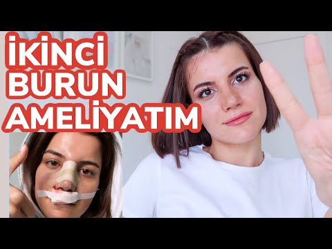 Video: Başarısız Bir Rinoplastiyi Nasıl Yaptım