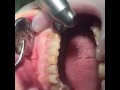 Лечение зуба с помощью лазера  #стоматология #лазер #зубы #пломбы #докторпиямов